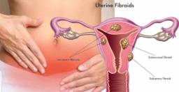 FIBROID.%0A